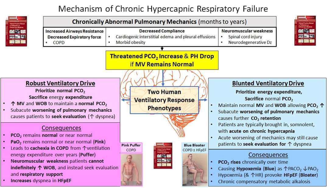 Exacerbation of OHS  =
HFpEF + Blunted Ventilatory Drive,  NOT NIV noncompliance
Focus on Euvolemia, Diuretic Dosing and 02 
<a href="/ASanchez_PS/">Andrew Sanchez</a> 
#pulmonary #Anesthesiology #cardiotwitter #EmergencyMedicine #meded  #CriticalCare #internalmedicine #hospitalist #hfpef PRTIYL