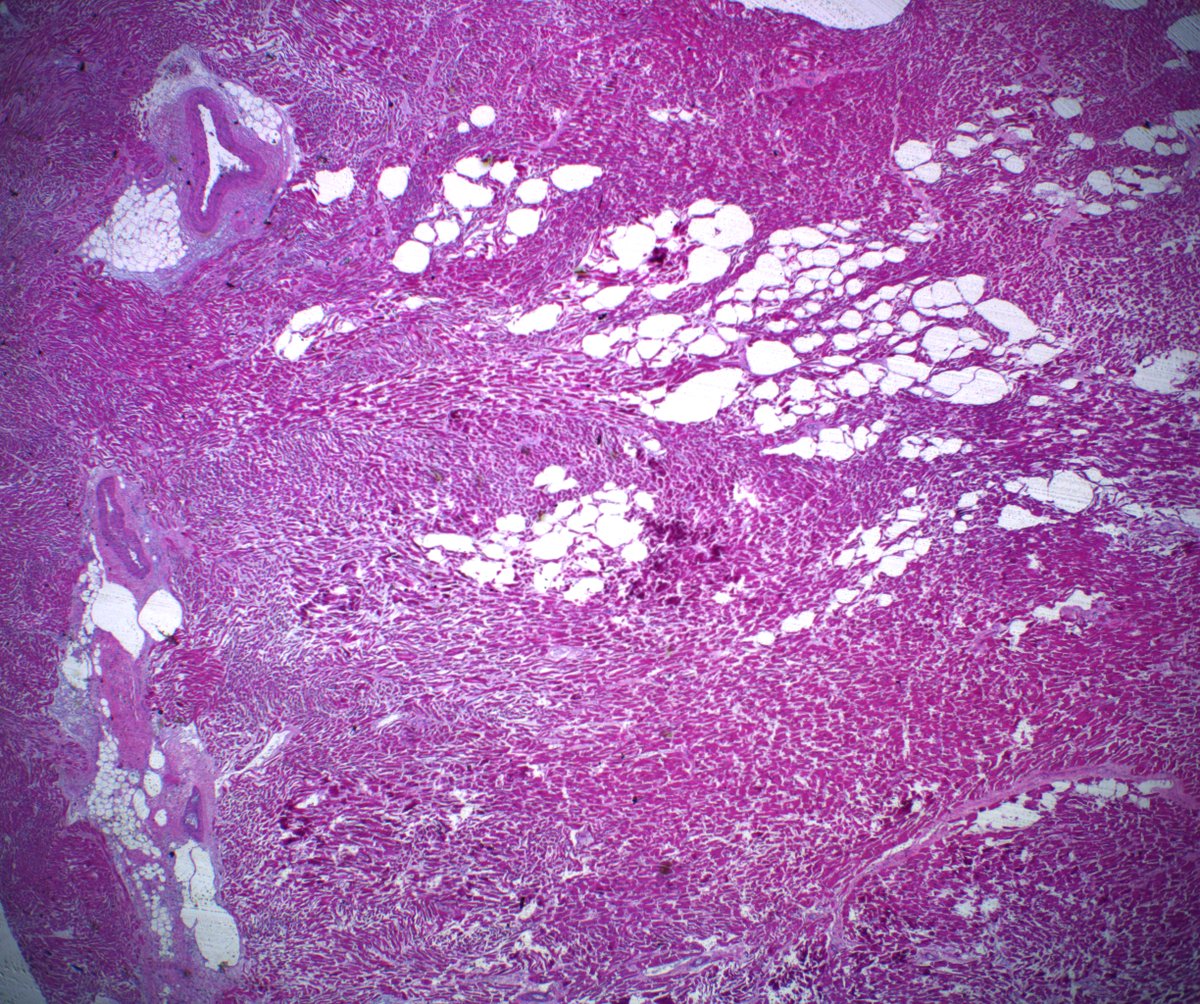 DanGrahamMD's tweet photo. 39M, 0.8cm lipomatous mass in posterior interventricular septum found incidentally at autopsy. No h/o MI or adjacent scarring. Anyone ever seen this/have a name for it? @leon_metlay #AutopsyPath #PathTwitter https://t.co/kMgWBvqr1V