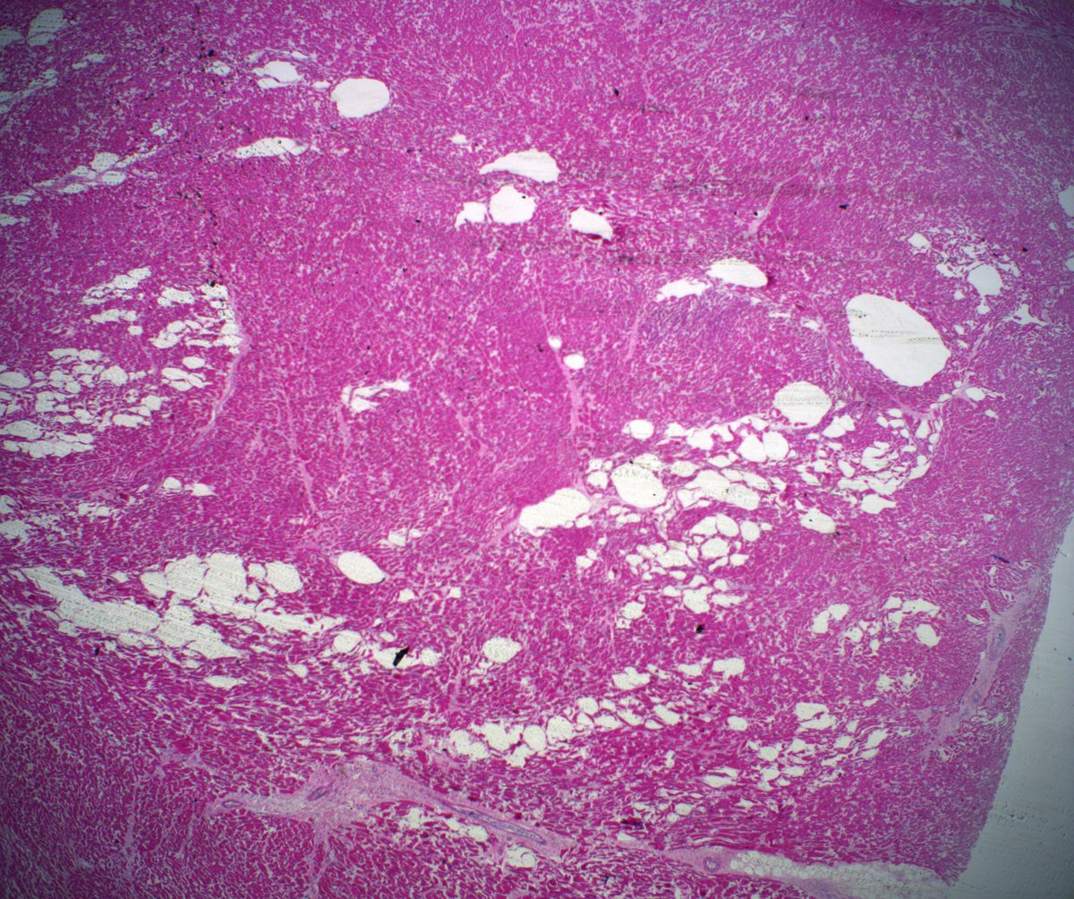 DanGrahamMD's tweet photo. 39M, 0.8cm lipomatous mass in posterior interventricular septum found incidentally at autopsy. No h/o MI or adjacent scarring. Anyone ever seen this/have a name for it? @leon_metlay #AutopsyPath #PathTwitter https://t.co/kMgWBvqr1V