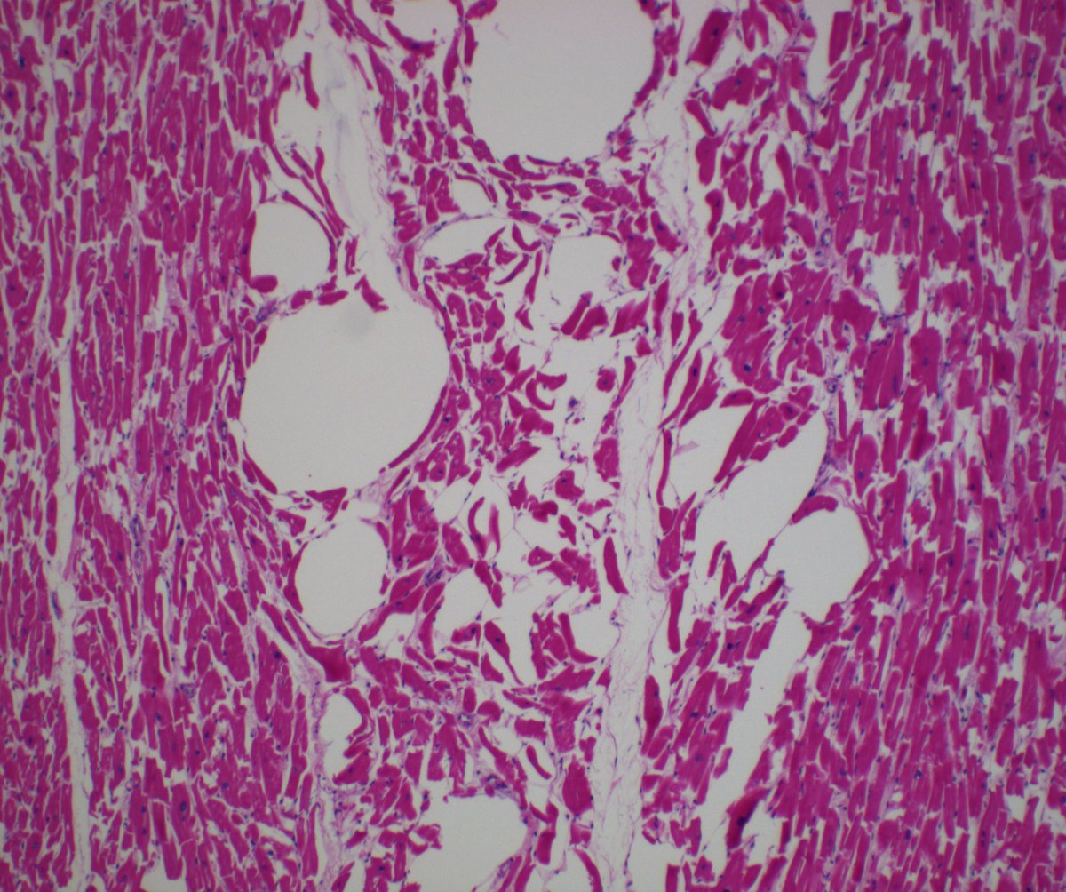 DanGrahamMD's tweet photo. 39M, 0.8cm lipomatous mass in posterior interventricular septum found incidentally at autopsy. No h/o MI or adjacent scarring. Anyone ever seen this/have a name for it? @leon_metlay #AutopsyPath #PathTwitter https://t.co/kMgWBvqr1V
