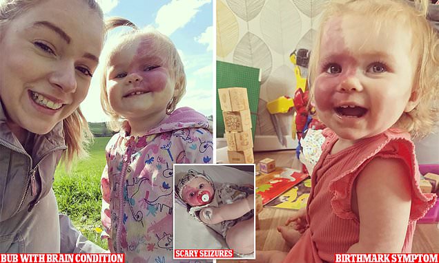 SturgeWeber's tweet photo. Sweet little Rosie made the news! @sws.and.rosie Thank you Rachael and Sam for being a SWS Warrior!
https://t.co/VB9iwf2XSY
#sturgewebersyndrome #swfunited https://t.co/lIfhTtkuW5