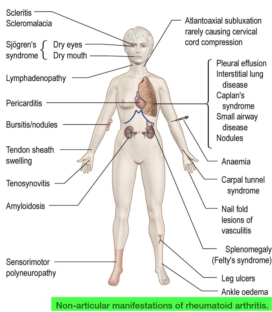 NTE®️N🅰️L Ⓜ️edℹ©️ℹne on Twitter "Extraarticular features of