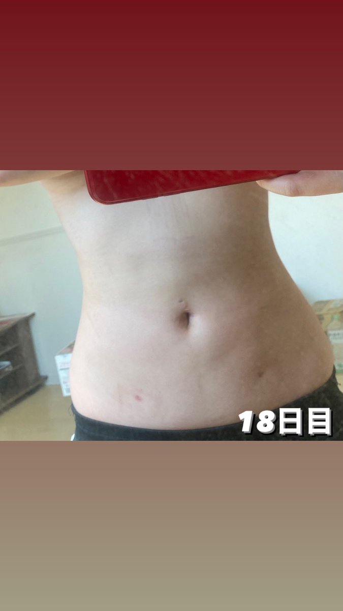 m_99893's tweet photo. エッジラインさんで脂肪吸引してきました！

部位は腹部360°➕ラブハンドル

写真じゃ分かりづらいけど下っ腹と横のラインがかなりスッキリ✨
ずっとお腹周りが気になってたからやって良かった🥰
@edgeline_jpkr https://t.co/1OpWKoxjeQ