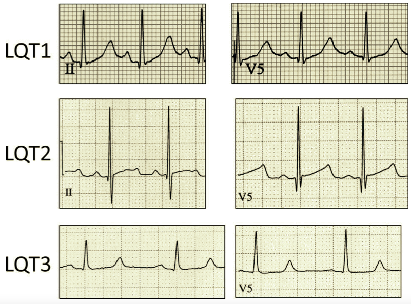 Recognising the type of Long QT syndrome is essential for management. #ECG #LQTS ;  LQT1: a broad T wave, LQT2 has a notched T wave with an asymmetrical appearance, LQT3 has a long isoelectric segment with a normal symmetrical T wave.