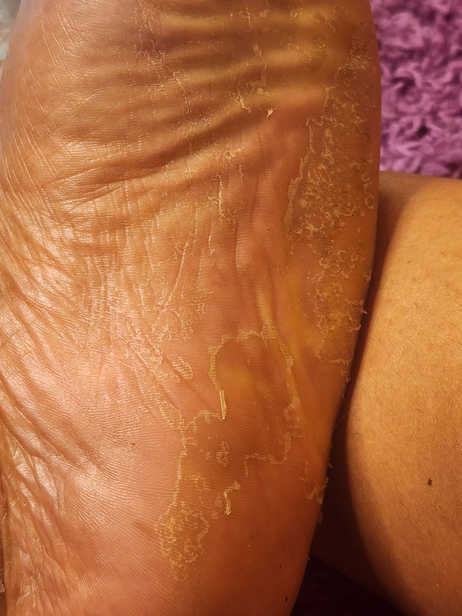BEAUTYBUNNNYY's tweet photo. The foot peel is PEELING!
SIX DAY RESULTS
#feet #bigsoles #footpeeling #FOOTFETİSH #widesoles #peel https://t.co/8G6kUYEYKl