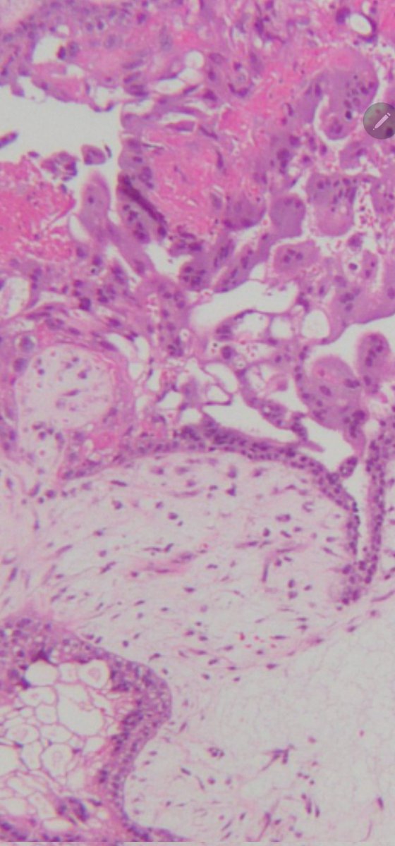 CerubbSilva's tweet photo. @leon_metlay I think that this aspect of the center of the inclusions are vacuolizations of the syncytiotrophoblast that already appears in a partial way just above, on the surface of this large villi https://t.co/2ZyLifGVsG