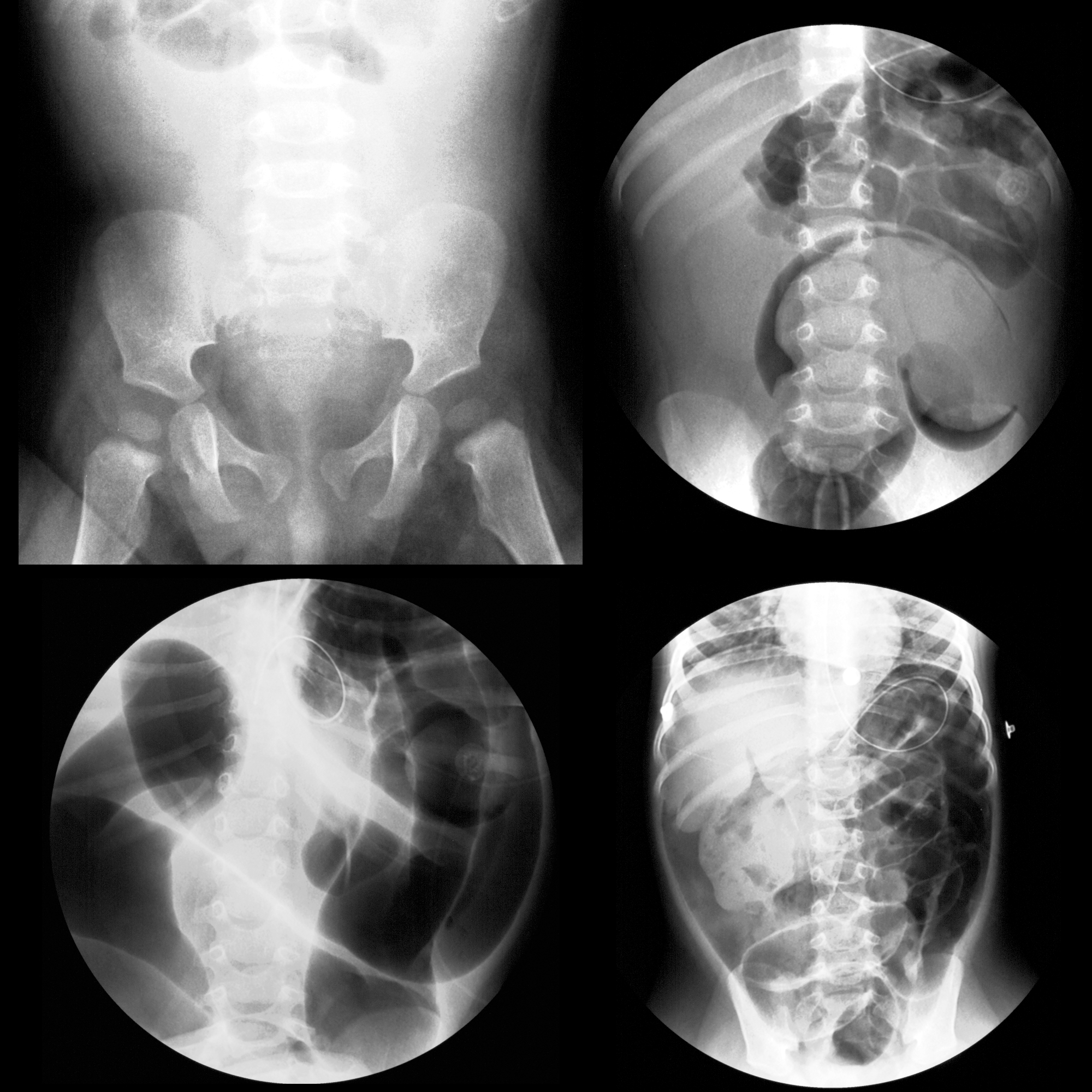 Pediatric imaging on twitter infant with crampy abdominal pain and a