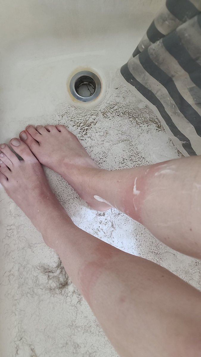 F*CKING... OW.
(I had my stilts on so tight that when I was moving, with my thigh high socks being underneath, I gave myself a friction burn)
Right leg had yellow liquid under  the red skin. 🤮 
Shaving my legs so the bushy leg hair doesn't irritate it when I go to sleep.