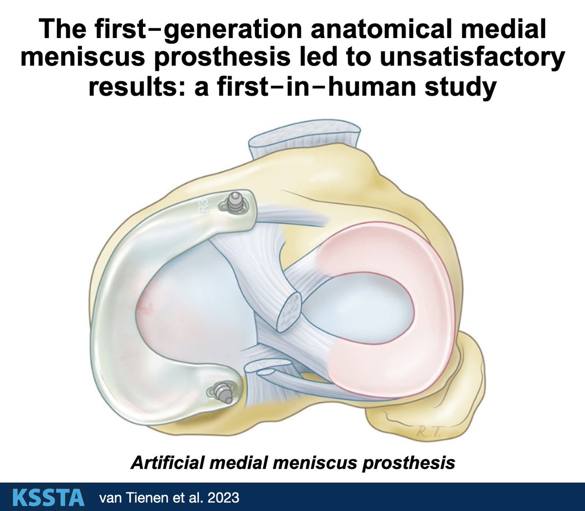 KSSTA's tweet photo. This first version of the #meniscusprosthesis led to impaired #kneefunction and failed in four out of five patient

#meniscus #sportsmedicine

Link: https://t.co/zyS0Ki5C1H https://t.co/kFFeSvMULf