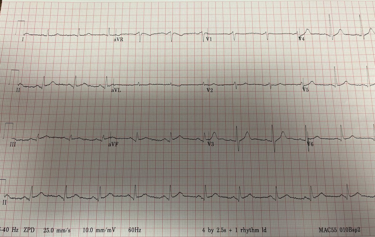 63 year old with "good story for ACS" but negative troponins.....

hqmeded-ecg.blogspot.com/2023/07/63-yea…