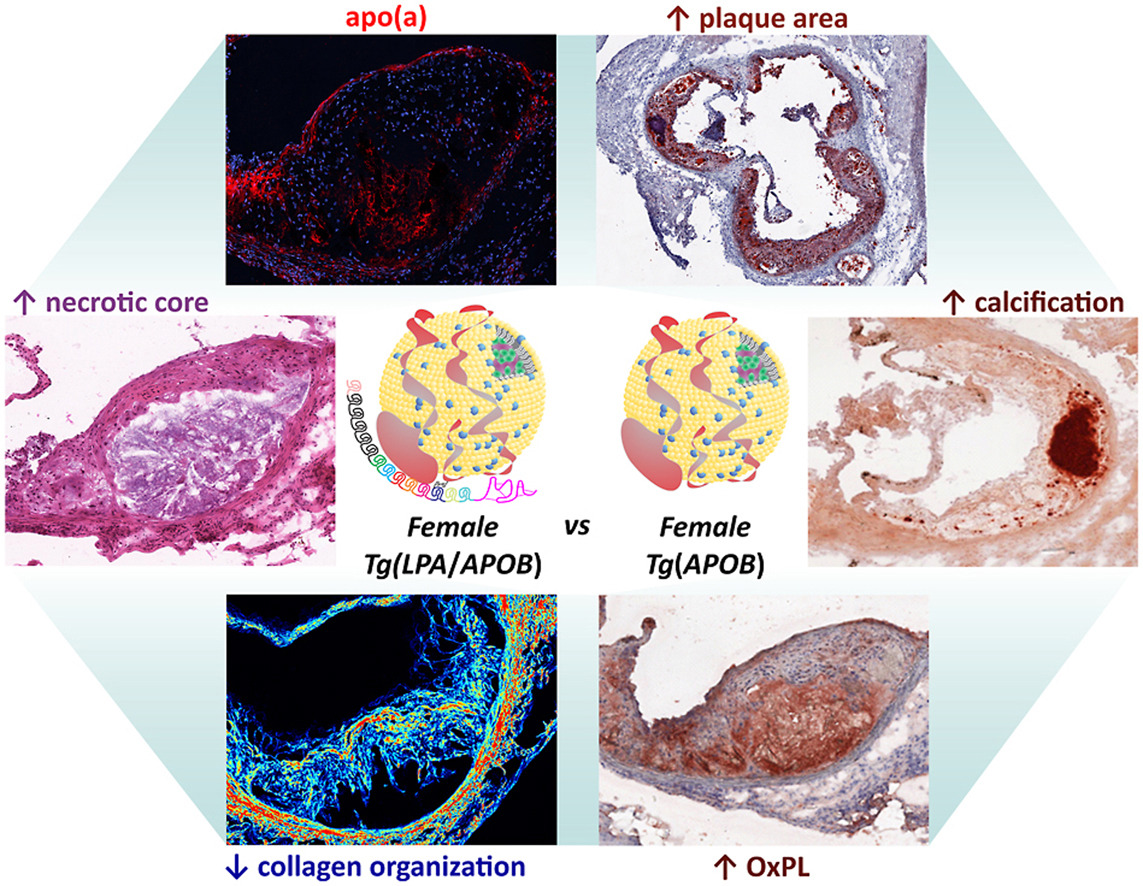 Findings by @JuliaStJohn253 @MarlysLPA @MBBoffa & al. suggest a pro-inflammatory phenotype exhibited by female Tg 🐁 expressing Lp(a) that appears to contribute to the development of more severe lesions with greater vulnerable features #Lpa @society_eas atherosclerosis-journal.com/article/S0021-…