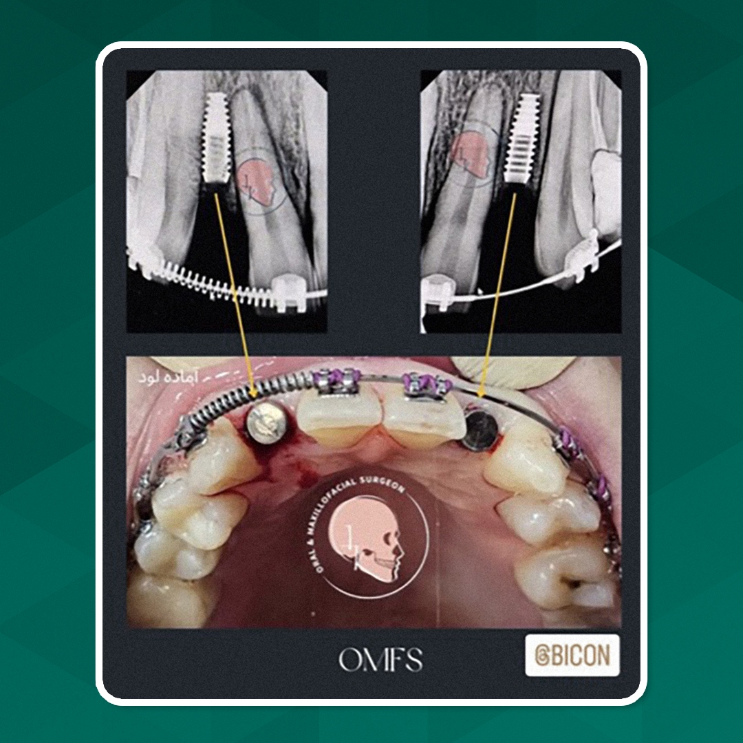bicon's tweet photo. ONLY BICON! From Dr. Hamed Kermani in Iran: “In orthodontic patients with insufficient space, I prefer Bicon implants, whose design lets me do the job without harming nearby teeth.” @dr.hamedkermani.omfs Thank you! 👏 #onlybicon #shortimplants #dentalimplants #biconisasolution https://t.co/5s75uZ29Ds