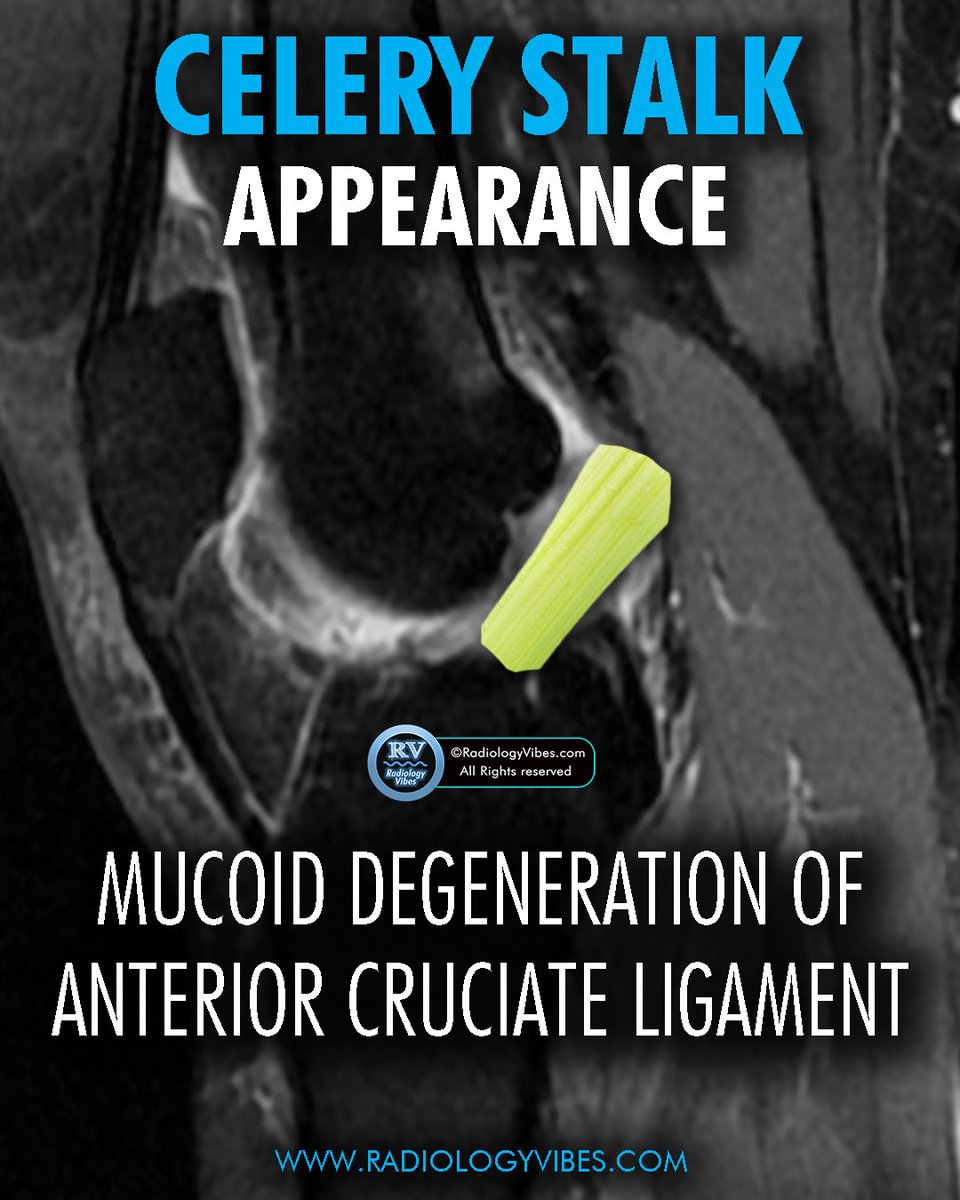 Celery stalk sign: the distinct appearance of the anterior cruciate ligament (ACL) with mucoid degeneration, resembling a celery stalk. 

#Radiology #MedTwitter  #radres #FOAMRAD