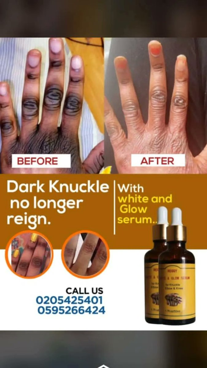 RTruevine's tweet image. #KNUST 
#reggytruevine #xtracurvesgh #reggyxtracurvesgummy #reggyxtrocurvesplus 
#weightgain #slimthick #booty #hourglass
#detox  #gainweight
#apetaminweightgain #waistshaper 
#buttenhancementpills #HipsandCurves  #unitedshowbiz #reggyherbaleyetea  #biggerbutt #widderhips #sexy