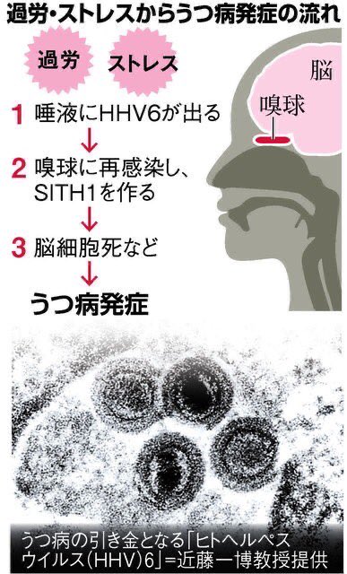 HHV6は、赤ちゃんの病気である突発性発疹の原因ウイルスで、ほぼ全ての人が乳幼児期に感染し、以降ずっと、体内に潜伏感染している→体が疲れると、HHV6は目覚める→唾液中に出てくる→嗅球に再感染し「SITH1」というたんぱく質が作られる→この働きで脳細胞死などを起こす→うつ病発症