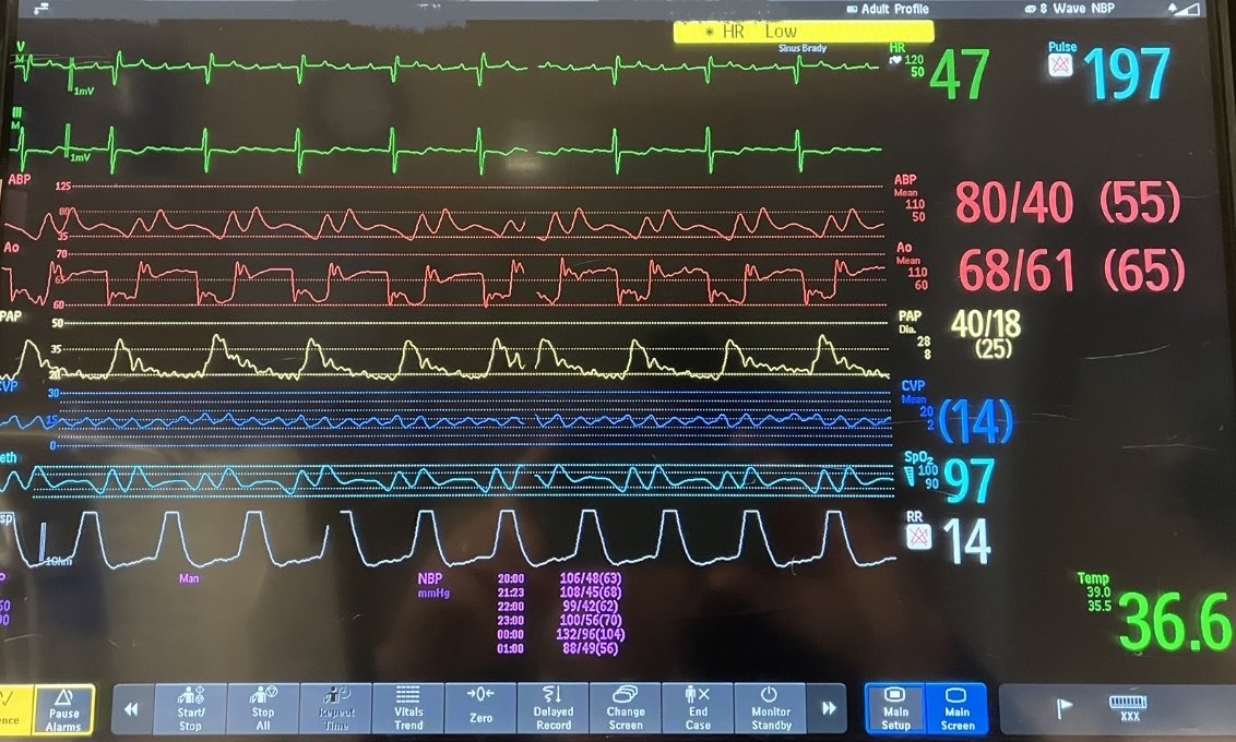 Waveform Quiz: what’s the actual HR and what are the sources of ...