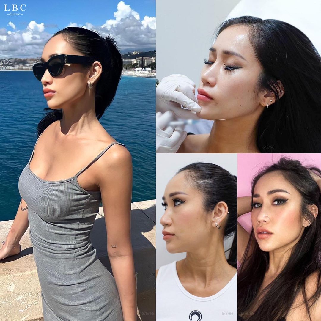LBCClinic's tweet photo. กรอบหน้าชัดแบบดารา ไม่ต้องผ่า สร้างได้จริง ฟิลเลอร์ Jawline กรอบหน้าคม ยกกระชับแบบสาย ฝ. หมอที่ LBC จัดให้ค่ะ 2 cc 18,000 บาท + ทำพร้อมปรับรูปหน้า Size XXL 13,900 บาทได้ค่ะ https://t.co/Lh7j29hCYE
