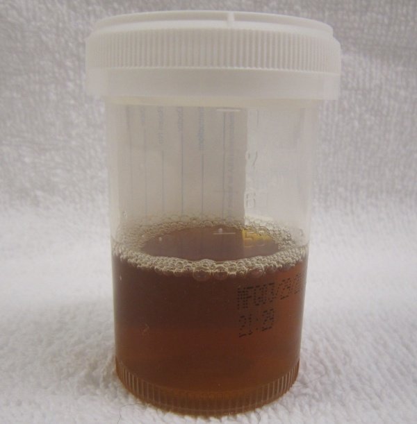 Drgomathi_tn's tweet photo. A 67 yo male p/w abdominal pain over the past few days,fever,nausea,anorexia,brown urine,yellow sclerae&amp; skin.He reported ingesting the below shown legume, 3 days ago. What is the missing enzyme in this patient?
#MedTwitter #medicine #Medaed #medicalstudents #MedEd #hematology https://t.co/ktxL9yRTQ9