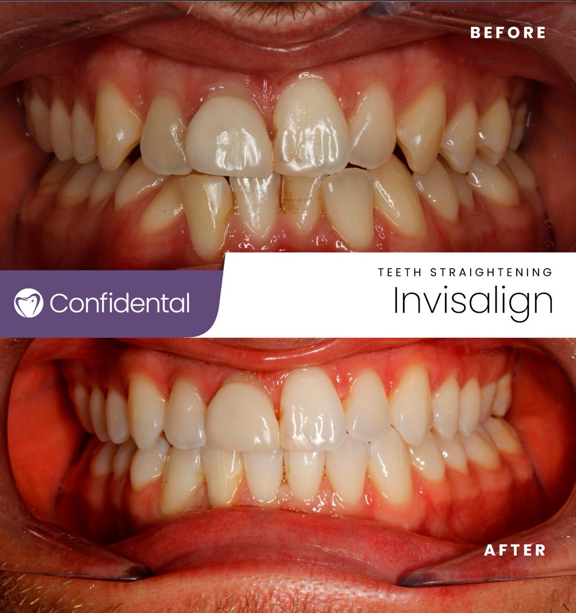ConfidentalUK's tweet photo. 📣 Check out this incredible transformation! 😍✨
 Schedule your FREE consultation today with our smile advisor today so you too can have a similar change
#InvisalignTransformation #BeforeAndAfter #SmileMakeover #ConfidenceBoost #InvisibleAligners #StraightTeeth #NewSmileJourney https://t.co/FcHSOhleDF