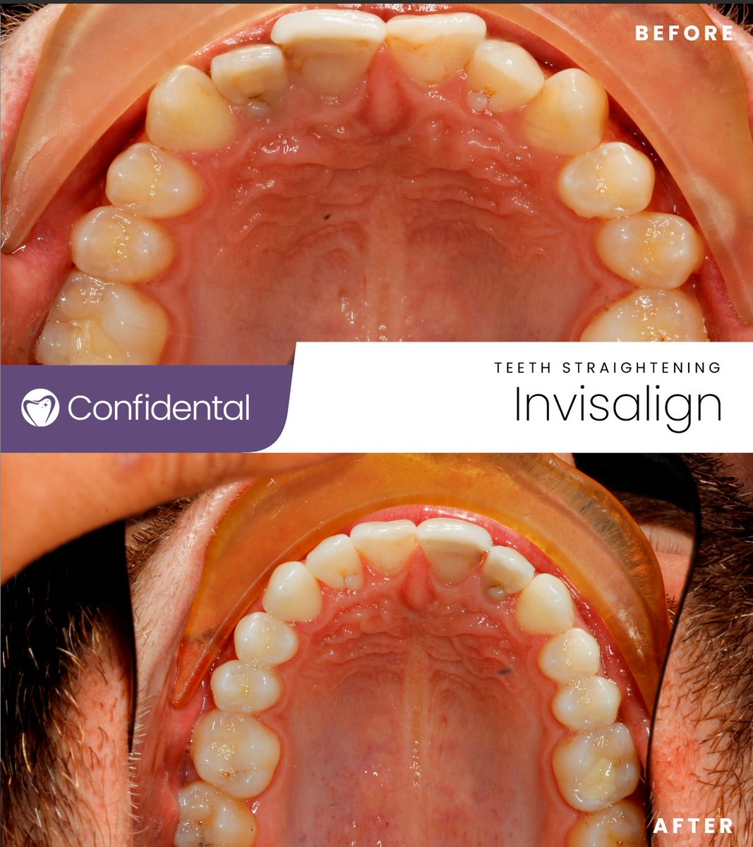 📣 Check out this incredible transformation! 😍✨ Schedule your FREE consultation today with our smile advisor today so you too can have a similar change #InvisalignTransformation #BeforeAndAfter #SmileMakeover #ConfidenceBoost #InvisibleAligners #StraightTeeth #NewSmileJourney