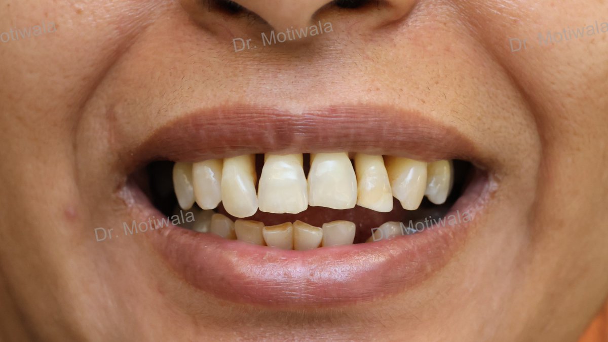 drmotiwaladcic's tweet image. A patient visits from the USA to get her treatment done in single visit to India

full mouth implants before and after

✅Single Visit
✅No Bone Graft
✅Single Piece Basal Implant 
✅Monolith Zirconia bridge (non-chipping)
#zirconiabridge #basalimplants #USA #Hyderabad #India