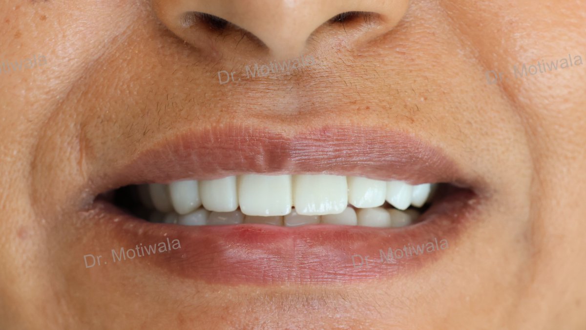 drmotiwaladcic's tweet image. A patient visits from the USA to get her treatment done in single visit to India

full mouth implants before and after

✅Single Visit
✅No Bone Graft
✅Single Piece Basal Implant 
✅Monolith Zirconia bridge (non-chipping)
#zirconiabridge #basalimplants #USA #Hyderabad #India