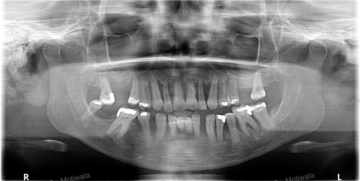 drmotiwaladcic's tweet image. A patient visits from the USA to get her treatment done in single visit to India

full mouth implants before and after

✅Single Visit
✅No Bone Graft
✅Single Piece Basal Implant 
✅Monolith Zirconia bridge (non-chipping)
#zirconiabridge #basalimplants #USA #Hyderabad #India