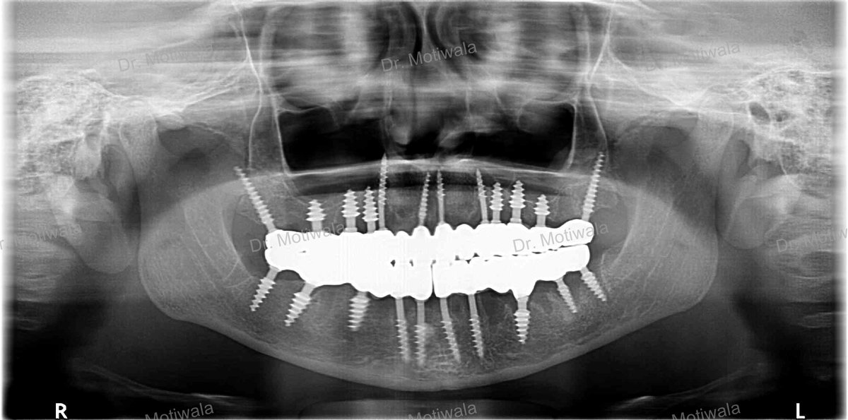 drmotiwaladcic's tweet image. A patient visits from the USA to get her treatment done in single visit to India

full mouth implants before and after

✅Single Visit
✅No Bone Graft
✅Single Piece Basal Implant 
✅Monolith Zirconia bridge (non-chipping)
#zirconiabridge #basalimplants #USA #Hyderabad #India
