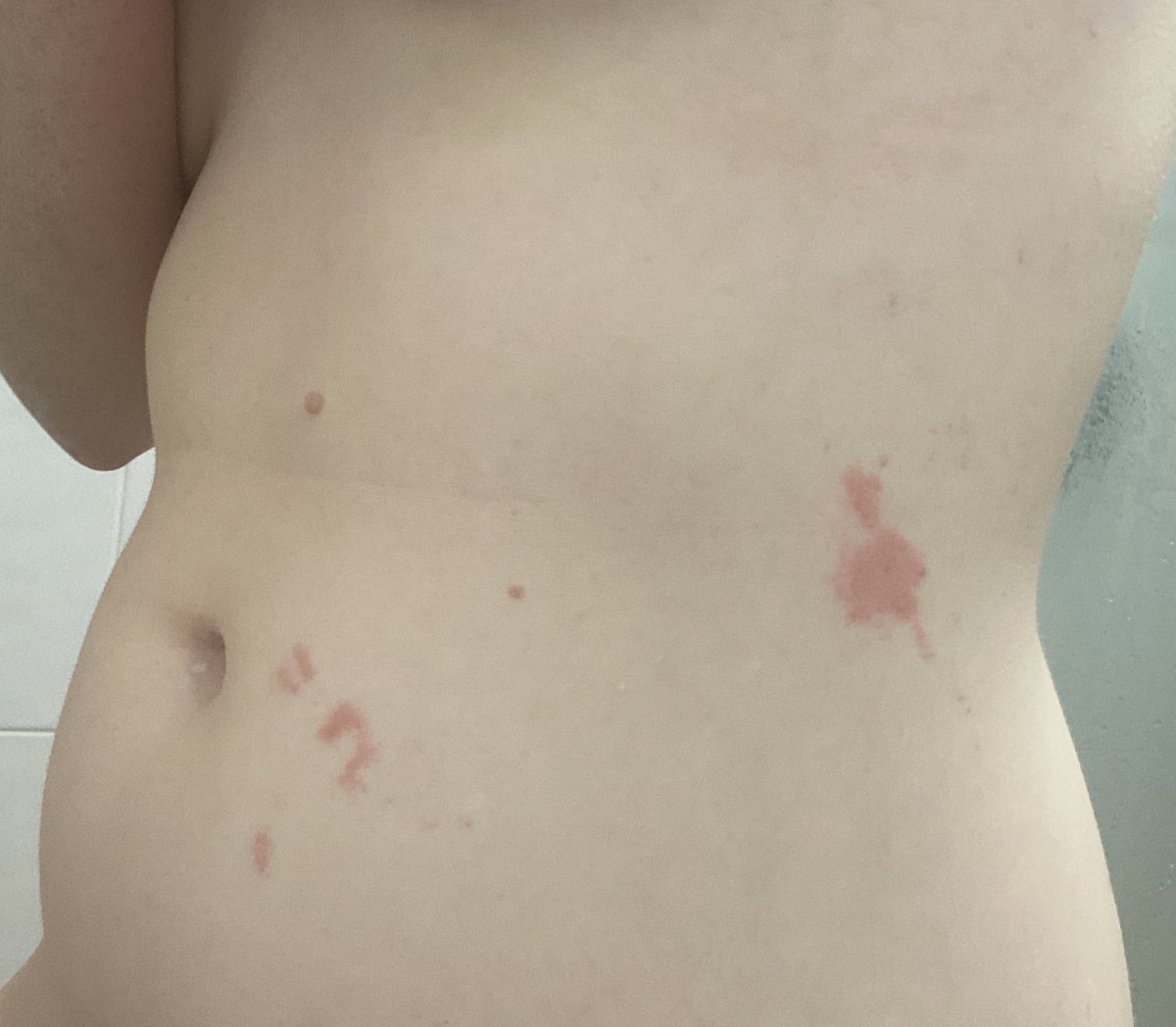 MissRedRage's tweet photo. $4000 robo debt from @centrelinkgovau 

And diagnosed with shingles. 

On top of osteoporosis and vertigo. 

I’m so breaking my 3 year dry streak. 

Drinks up bois. https://t.co/STqjqimKES