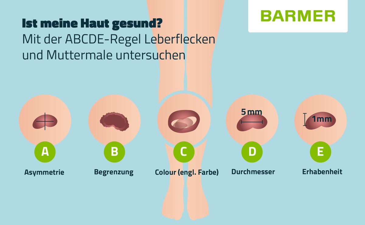 BARMER_Presse's tweet photo. Am heutigen Bleib-aus-der-Sonne-Tag verraten wir, was genau es mit der ABCDE-Regel auf sich hat. Diese hilft, #Pigmentmale, #Muttermale und #Leberflecken zu beurteilen. 👉 https://t.co/4dwCpNO8XO https://t.co/ZmmoH53ulZ