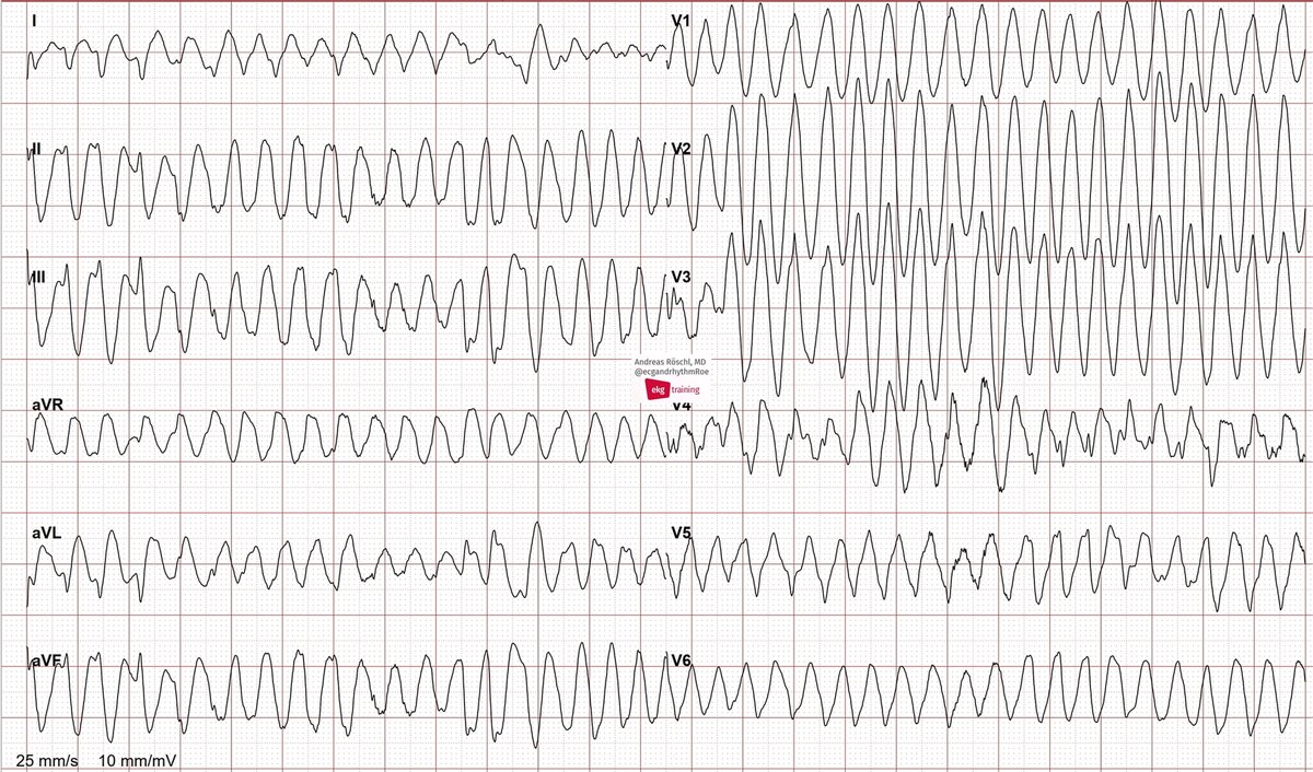 2 ECGs 1 min. apart during exercise-ECG. Why did this happen?