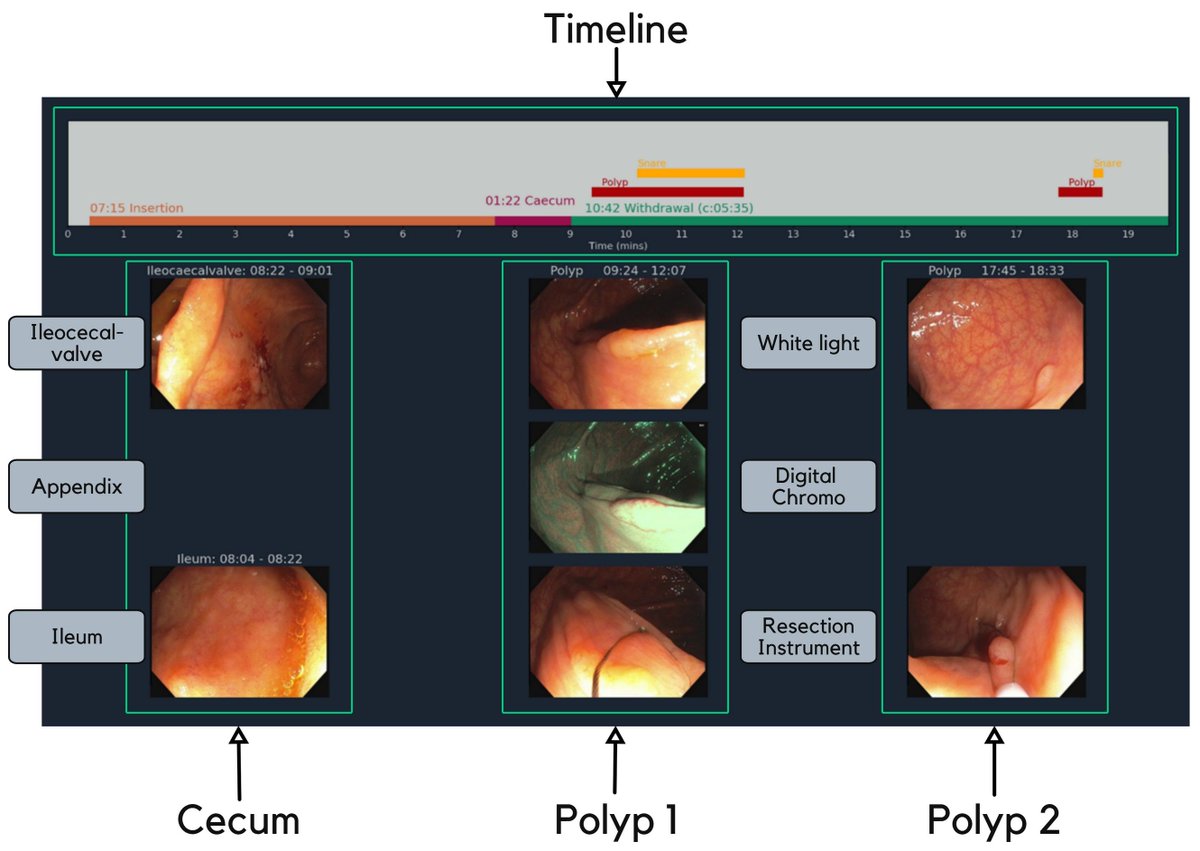 Alexander Hann (@alexsworking) on Twitter photo Here is the GUI
Hopefully interesting for #AI in #endoscopy #legends
<a href="/tberzin/">Tyler Berzin MD, FASGE</a> <a href="/sravmd/">Sravanthi Parasa MD</a> <a href="/UriKopylov/">Uri Kopylov</a> <a href="/tpseraphin/">Tobias P. Seraphin</a> <a href="/TomKonikoff/">Tom Konikoff, MD</a> <a href="/jglissenbrown/">Jeremy Glissen Brown MD, MSc</a> <a href="/RawenKader/">Rawen Kader</a> <a href="/lena_maierhein/">Lena Maier-Hein New: @lena-maier-hein.bsky.social</a> @andre4cherubini <a href="/debesh_jha/">Debesh Jha</a> <a href="/NayantaraCoelho/">Nayantara Coelho</a> <a href="/tom_luedde/">Tom Luedde</a> <a href="/KMonkemuller/">Klaus Mönkemüller, MD, PhD</a> <a href="/drkeithsiau/">Keith Siau</a> <a href="/GI_Pearls/">GI Pearls</a> <a href="/kelkalot/">Michael Alexander Riegler</a> Here is the GUI
Hopefully interesting for #AI in #endoscopy #legends
<a href="/tberzin/">Tyler Berzin MD, FASGE</a> <a href="/sravmd/">Sravanthi Parasa MD</a> <a href="/UriKopylov/">Uri Kopylov</a> <a href="/tpseraphin/">Tobias P. Seraphin</a> <a href="/TomKonikoff/">Tom Konikoff, MD</a> <a href="/jglissenbrown/">Jeremy Glissen Brown MD, MSc</a> <a href="/RawenKader/">Rawen Kader</a> <a href="/lena_maierhein/">Lena Maier-Hein New: @lena-maier-hein.bsky.social</a> @andre4cherubini <a href="/debesh_jha/">Debesh Jha</a> <a href="/NayantaraCoelho/">Nayantara Coelho</a> <a href="/tom_luedde/">Tom Luedde</a> <a href="/KMonkemuller/">Klaus Mönkemüller, MD, PhD</a> <a href="/drkeithsiau/">Keith Siau</a> <a href="/GI_Pearls/">GI Pearls</a> <a href="/kelkalot/">Michael Alexander Riegler</a>