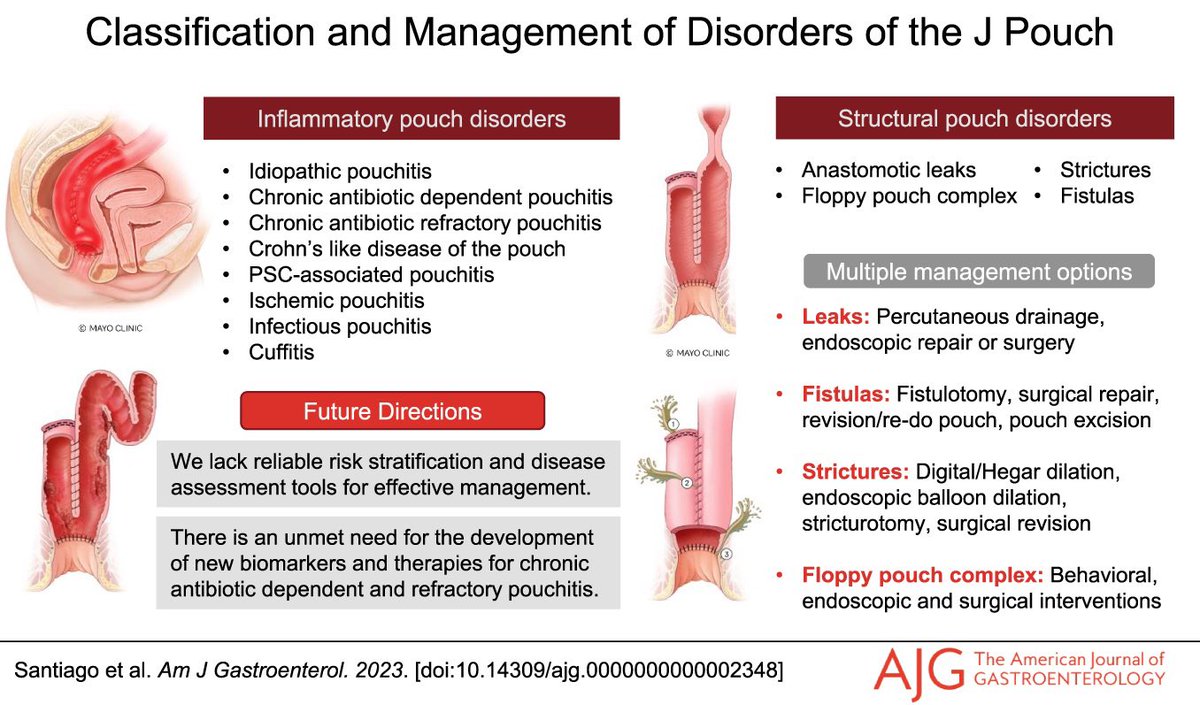 ❓Do you want to know more about #pouchitis treatment and management of complications of the J pouch? 📄 Check out our new AJG review paper below! ⭐️Thank you so much to my phenomenal mentors Dr. @LauraRaffalsMD and Dr. @EdBarnesMD!! journals.lww.com/ajg/Abstract/9…