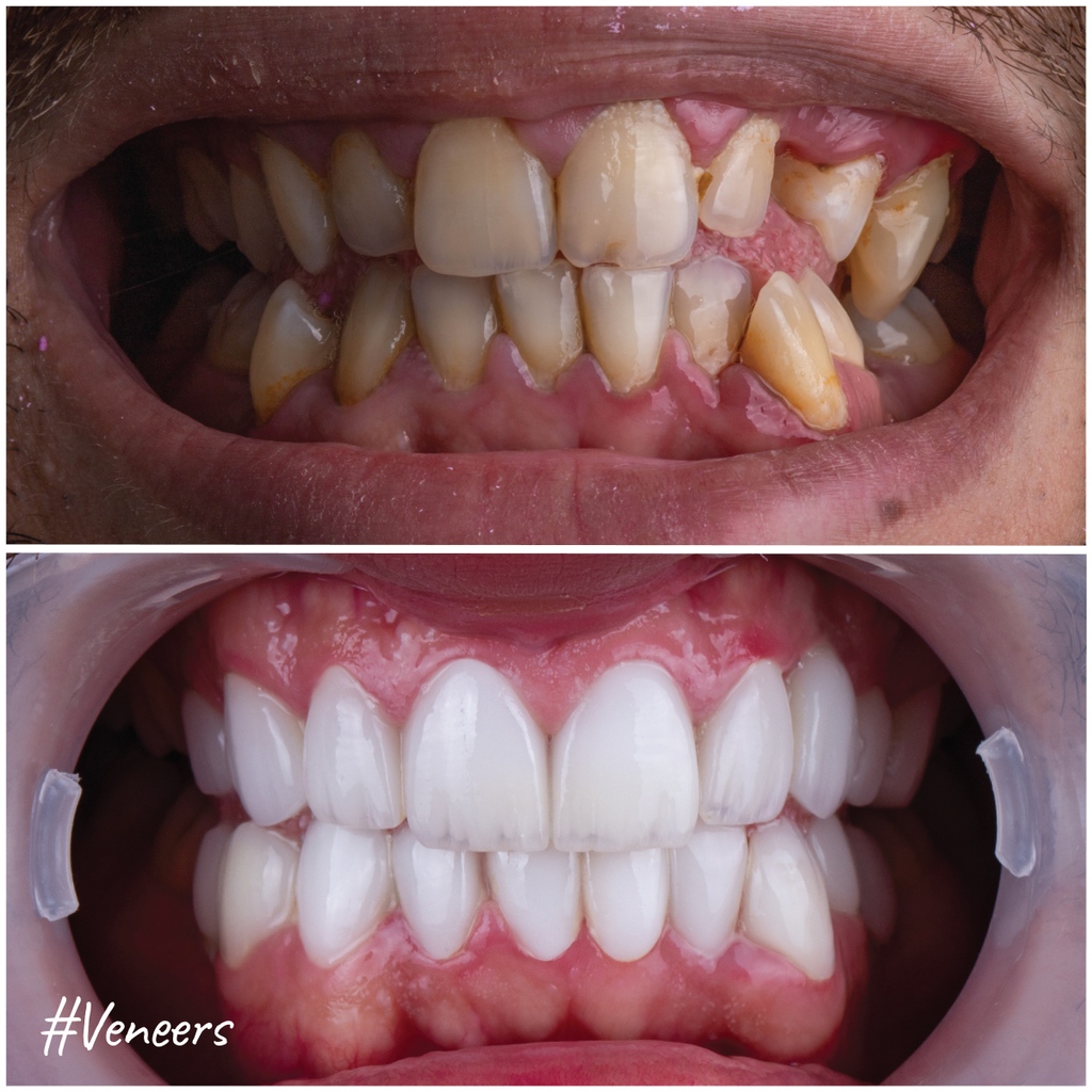 MicrisDental's tweet image. In this case, the patient's #crowdedteeth, #biteproblems &amp;amp; #teethmisalignment posed a #challenge for our #dentalspecialist, Dr. Khaled Abdelhady.

But, under Dr. Khaled's specialized care, the patient's #confidence soared with a restored bite &amp;amp; a beautifully aligned #smile.