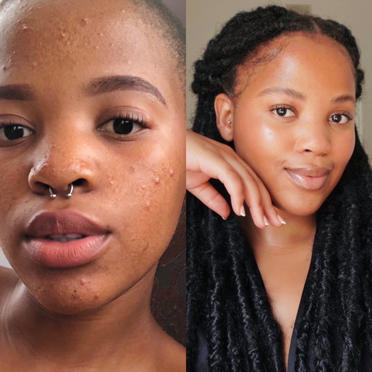 zithobemacheli's tweet image. It is only now that I truly understand when they say, “everything happens for a reason” because my journey with acne was leading me to my purpose and it was the universe’s way of showing me that I can transcend something painful into something beautiful, powerful and impactful ❤️