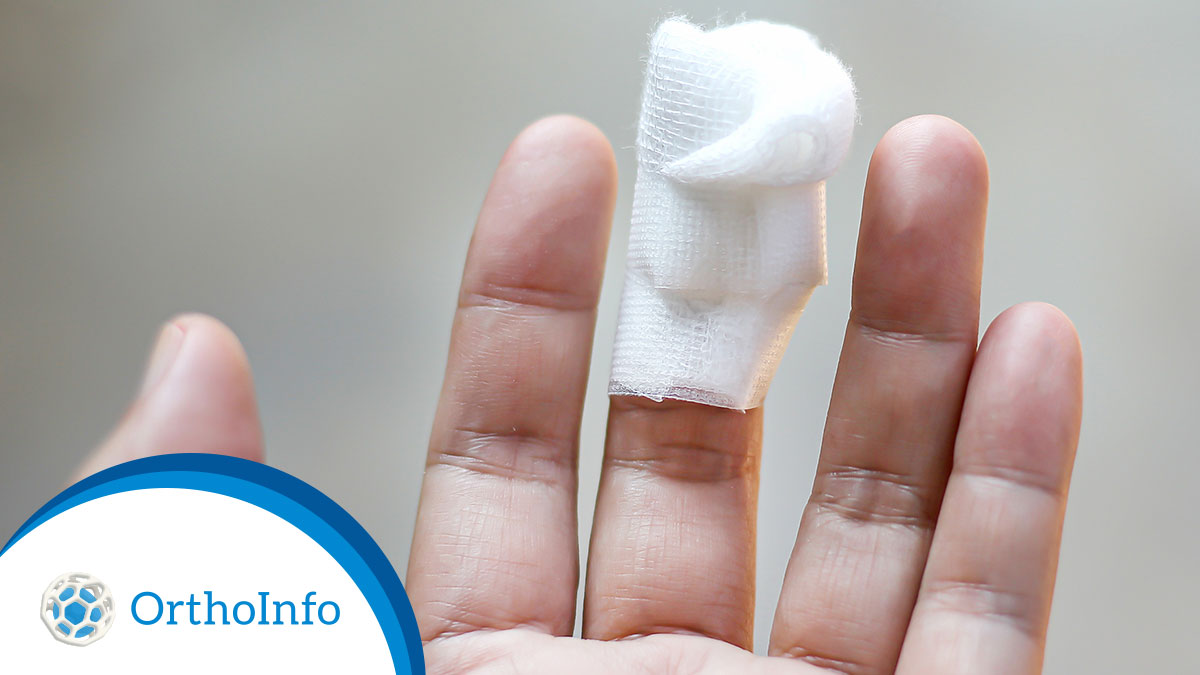 AAOS1's tweet photo. Some #fourthofjuly safety advice from #OrthoInfo: Leave the #fireworks to the experts. But if you do suffer a finger injury or amputation in a firework mishap, follow these first aid tips for the best outcome: https://t.co/qmEUynaIcZ #Orthotwitter @HandSociety @aaeminfo https://t.co/sJkmI7oOcq