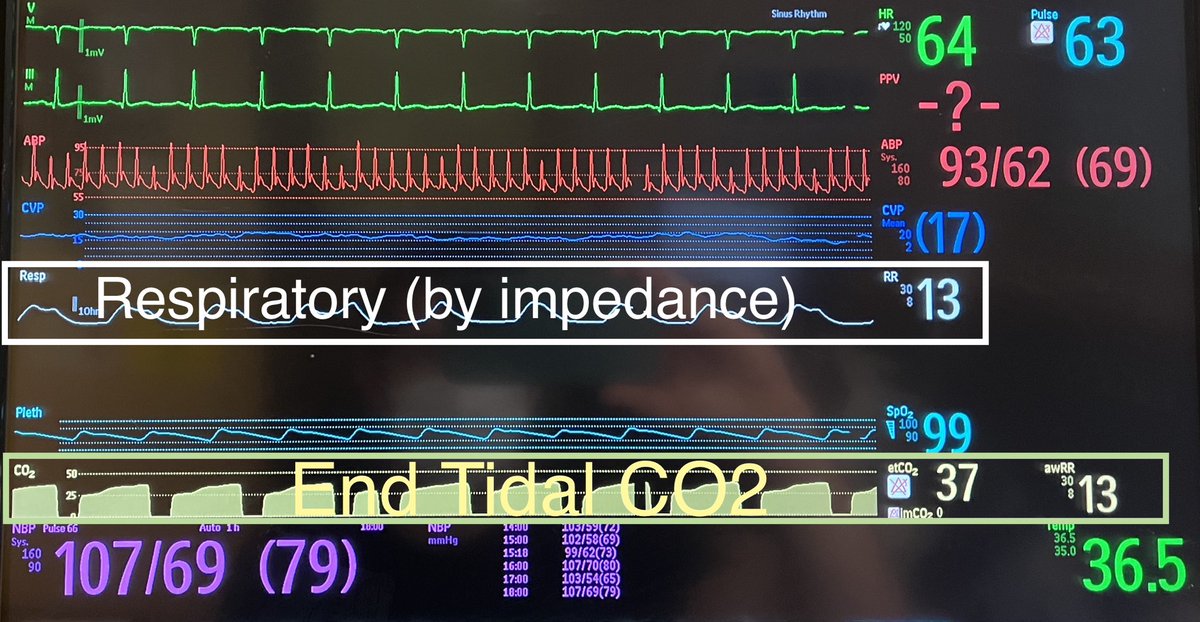 Waveform Quiz: what’s the actual HR and what are the sources of ...