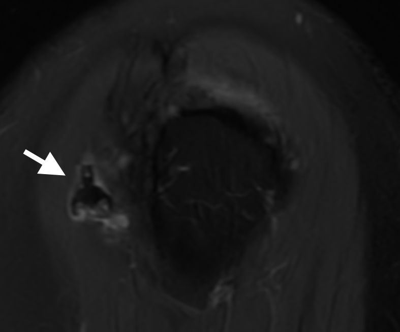 What is this displaced foreign thing that looks like a nanorobot #orthotwitter after LHBT tenodesis any name for this?