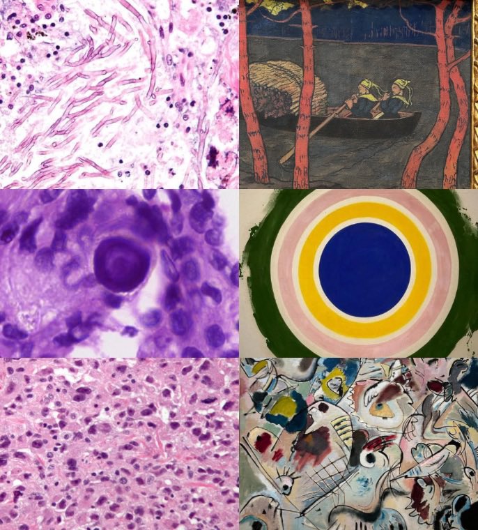 When a pathologist walks into an art gallery 🖼️😙

Feel free to comment on other art-path correlations. 

This is why path is so fun 🤩 

#medtwitter #PathTwitter #medart #medicalhumanities  #MedStudentTwitter #medical #med #medstudents