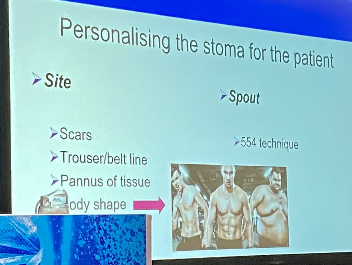 Azmina Rose (@azmina_rose) on Twitter photo Good talk by <a href="/N_Raj_/">Niroshini Rajaretnam</a> @ #ACPGBI2023 about the ‘perfect’ stoma. My 20mm diameter end #ileostomy must be close to perfect since I have no skin issues, brilliant bag adhesion, minimal leakage, no parastomal hernia etc. Made 20+ yrs ago by Peter Hawley <a href="/StMarksHospital/">St Mark's Hospital</a> #QualityOfLife Good talk by <a href="/N_Raj_/">Niroshini Rajaretnam</a> @ #ACPGBI2023 about the ‘perfect’ stoma. My 20mm diameter end #ileostomy must be close to perfect since I have no skin issues, brilliant bag adhesion, minimal leakage, no parastomal hernia etc. Made 20+ yrs ago by Peter Hawley <a href="/StMarksHospital/">St Mark's Hospital</a> #QualityOfLife