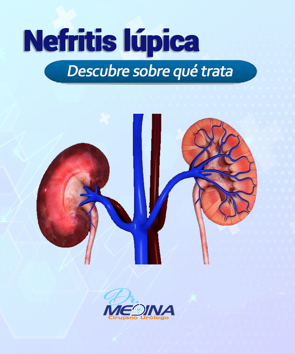 uroprotesis's tweet photo. Se produce cuando los anticuerpos del lupus afectan a estructuras en los riñones. Esto causa inflamación renal y puede llevar a que se presente sangre en la orina, proteína en la orina, presión arterial alta, deterioro de la función renal o incluso insuficiencia renal.⁣ https://t.co/XPWPV3lB3F