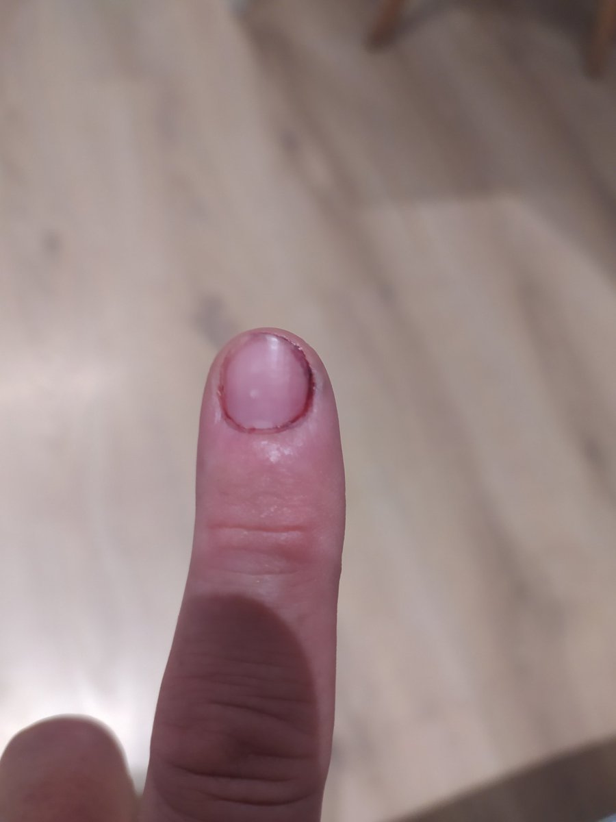 PeusLa's tweet photo. M'estic morint pel dit. https://t.co/20rKPZjmDW