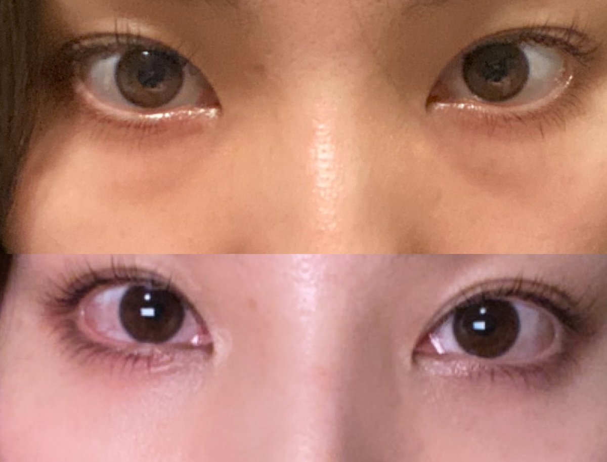 arisamanian's tweet photo. クマ取り手術から3週間経ちました🐻　上　術前
下　3週間後

どちらもすっぴんです。
脂肪によるクマは消えました🐻
写真だと分かりにくいですが目の下に影はあるので、これを消したい方は脂肪やヒアルを入れるのだろうなと思います。私はズボラなので影はハイライトで飛ばせばいいやーと思ってます笑 https://t.co/a5Lpn48zfM
