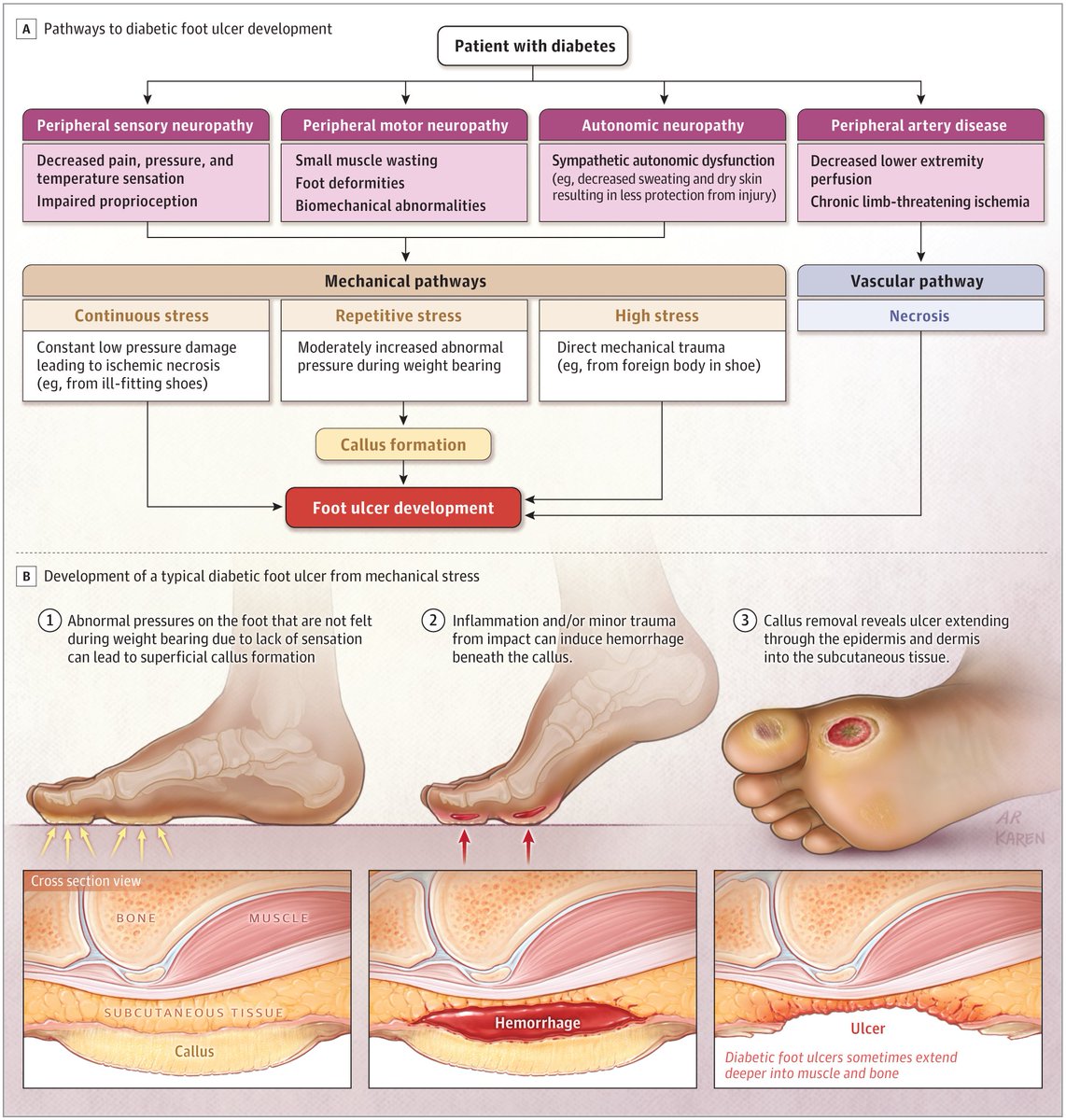 DGArmstrong's tweet photo. Discover the pathways that lead to diabetic foot ulceration in this insightful article from @JAMA_Current. Take action against amputation and learn more about diabetic foot care. #ActAgainstAmputation #DiabeticFoot #DFBlog https://t.co/xci7w5yln9 https://t.co/E2XTjCFTiN