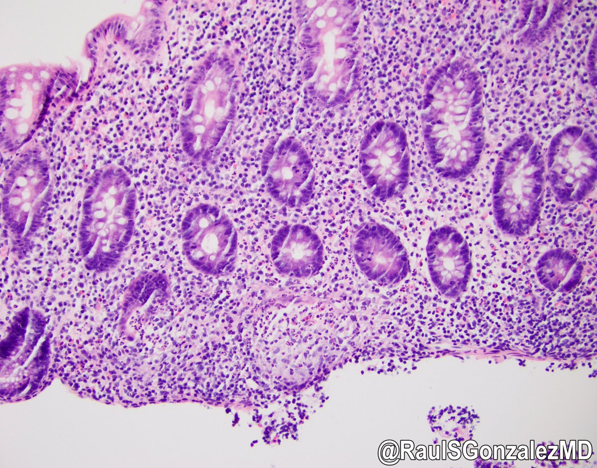 RaulSGonzalezMD's tweet image. Happy new (academic) year! Here's two #gipath tips for new #pathology interns: 1) H&amp;amp;E levels are your friend. 2) Granulomas don't automatically = Crohn disease in IBD patients. This colon bx from an ulcerative colitis patient shows crypt rupture granulomas, as levels prove.