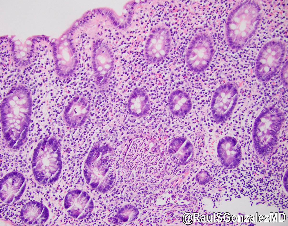 RaulSGonzalezMD's tweet image. Happy new (academic) year! Here's two #gipath tips for new #pathology interns: 1) H&amp;amp;E levels are your friend. 2) Granulomas don't automatically = Crohn disease in IBD patients. This colon bx from an ulcerative colitis patient shows crypt rupture granulomas, as levels prove.