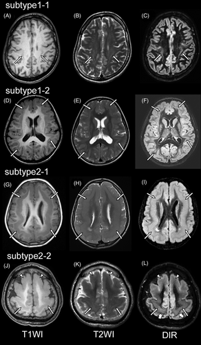 JNeuroimaging's tweet photo. Heterotopias in #brain formation are clinically important and easily missed. See how #neuroimaging can reveal them. #neurology #neuroscience #epilespy #seizure #neurorad #radres #neurosurgery #futureneurologist #neurotwitter #neurotwitternetwork

https://t.co/bNQjiokWDS https://t.co/cYPOzQWR2l