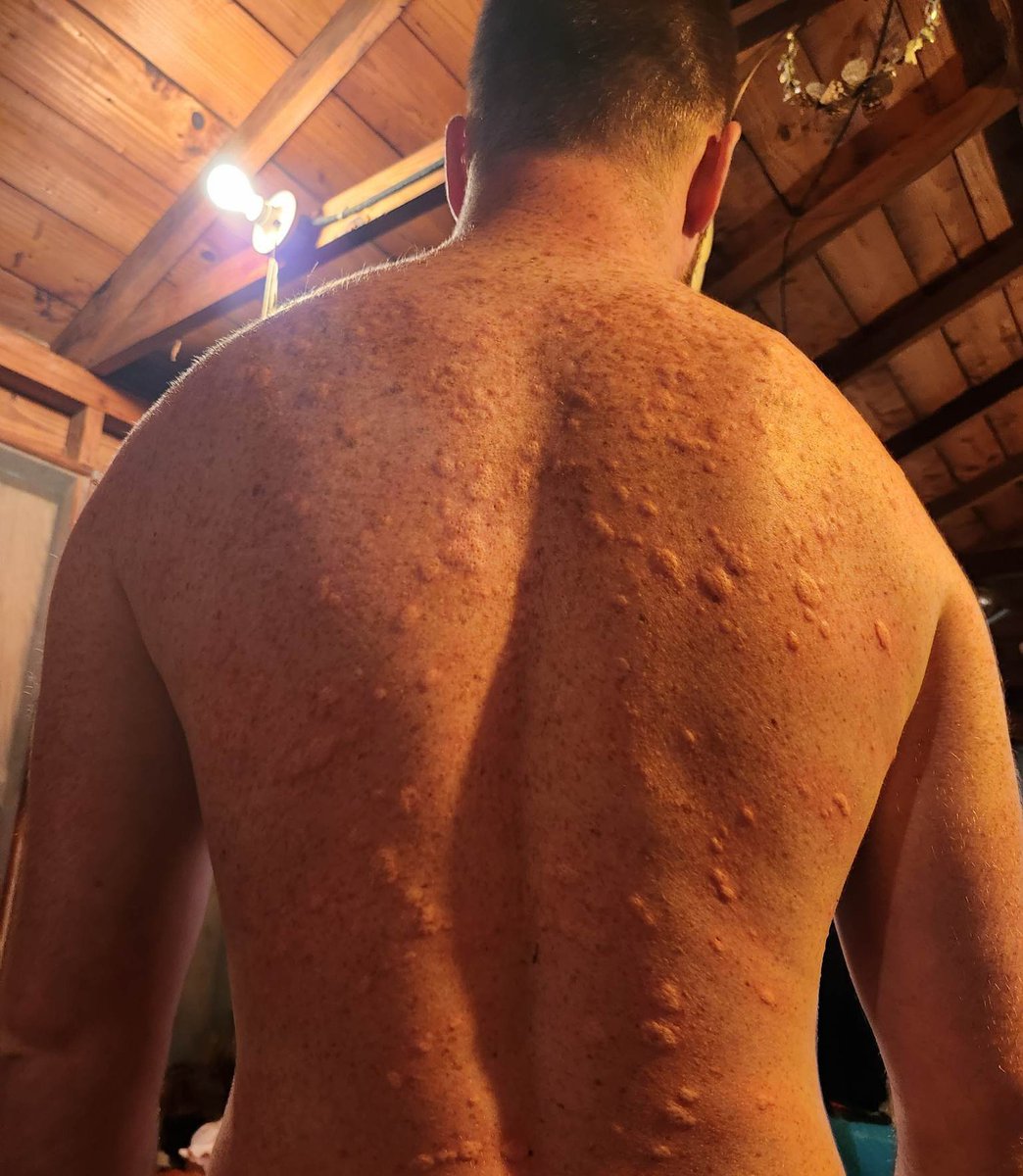 .<a href="/Iceman_Hof/">Wim Hof</a>

Have you ever studied cold urticaria?

I'm super curious as a person with cold urticaria if the benefits of cold water exposure are diminished because of it? 

Picture of my back after being out in cold rain.

This happens every time I take a cold shower/bath too.