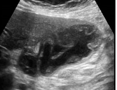 POCUSAcademy's tweet photo. A 38-year-old female presented with pain in the right upper abdomen. The following two images were obtained while scanning her gallbladder.

What is the most likely diagnosis?

A. Acute cholecystitis
B. Acute Gangrenous cholecystitis
C. Emphysematous cholecystitis https://t.co/CmEjbaJ8i0