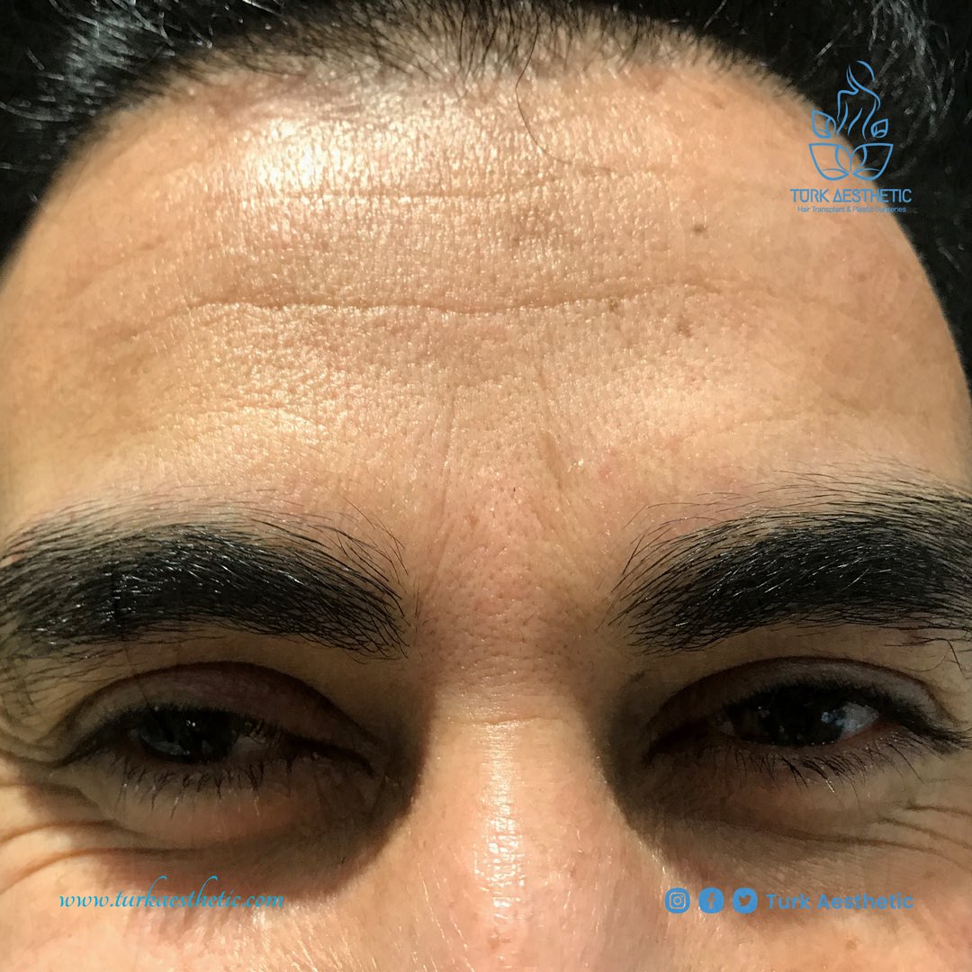 Before and After Botox injection

قبل وبعد حقن البوتوكس

#foreheadbotox #rejuvenateyourself #agelessbeauty #botoxinturkey #botoxinjections #botoxinjectionsistanbul #foreheadlinestreatment #dolgutürkiye #botokstedavisi #bótox
#botoxiniezioni #botoxprimadopo #injectionsbotox